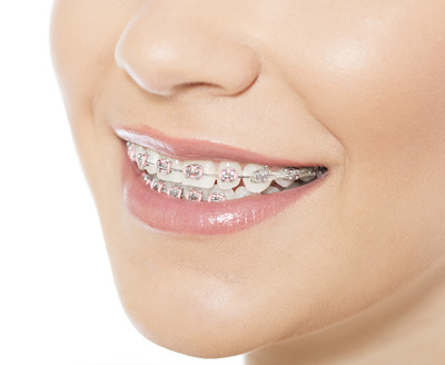 What Are Elastics for Braces? - Northenden House Orthodontics