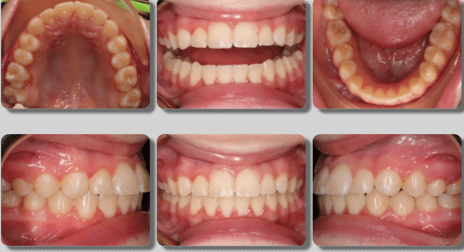 Crowding and Asymmetric Bite Treated with Braces- 25 months - After