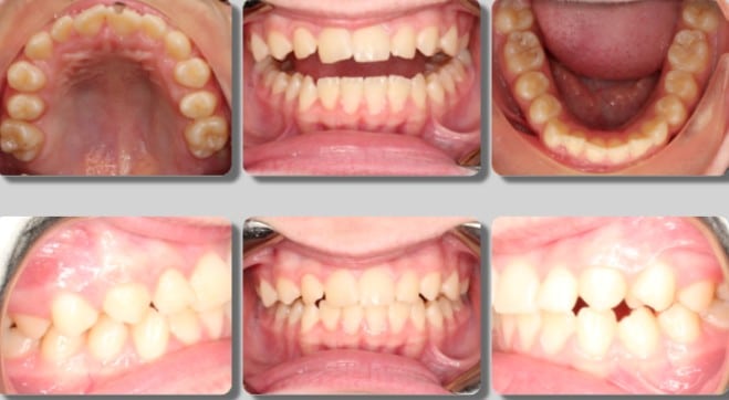 Crowding and Asymmetric Bite Treated with Braces- 25 months - Before