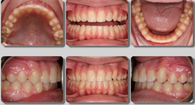 Crossbite and Crowding Treated with Expander and Braces- 25 months - After