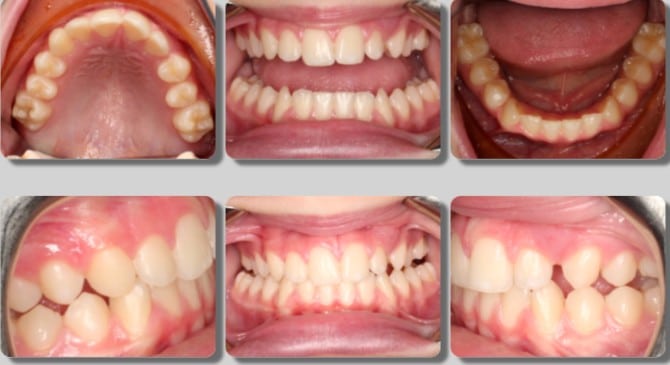 Crossbite and Crowding Treated with Expander and Braces- 25 months - Before